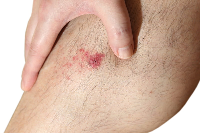Skin_ Infections_3