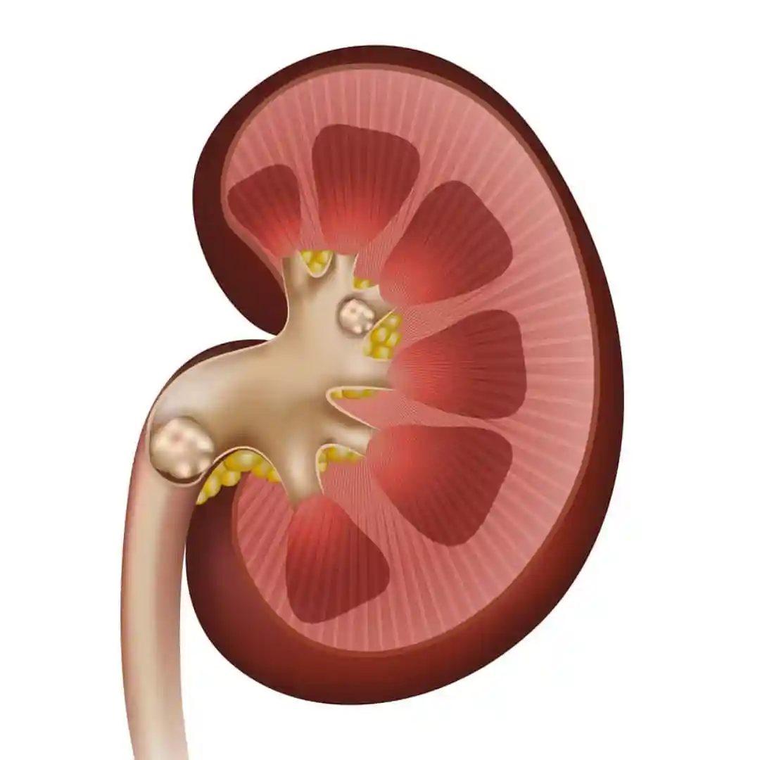 Renal Stones