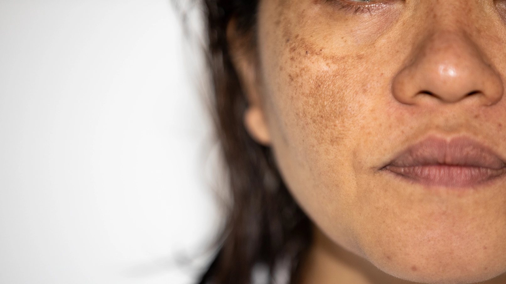 NNHyperpigmentation2_1276345099